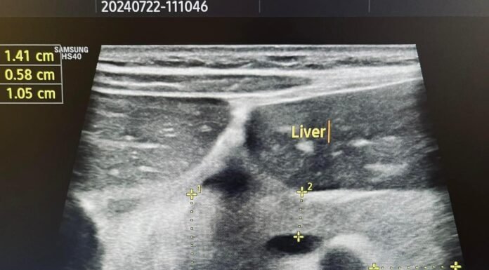 Цагаан гурил,Гурилан бүтээгдэхүүн их хэрэглэдэг том хүн болон хүүхдийн #Нойр_булчирхай, 12 хуруу гэдэс өвдөх магадлал их байдаг.